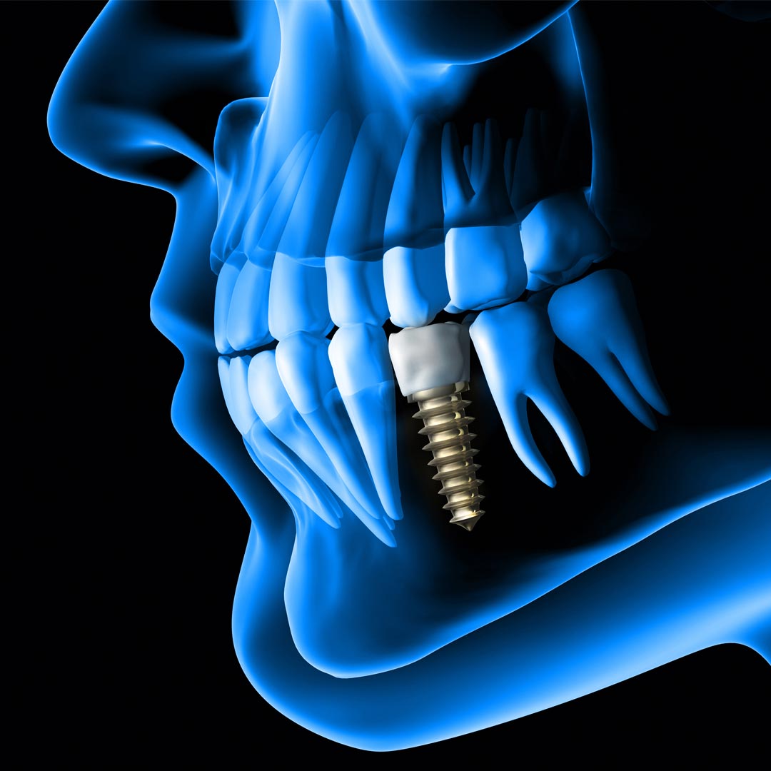 Same Day Dental Implant